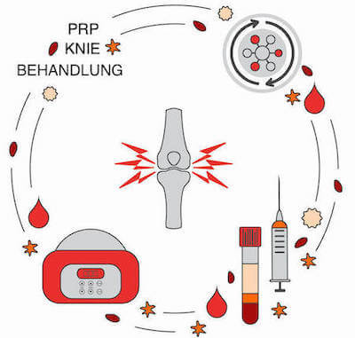 Beschreibung der PRP Behandlung am Knie