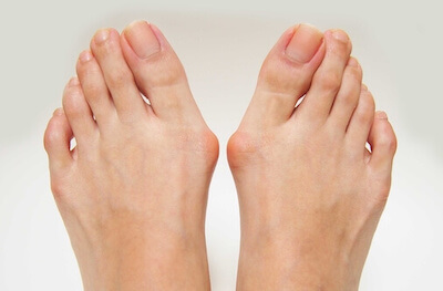 Schmerzhafter Hallux Valgus, der operiert werden muss