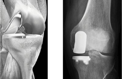 Implantat eines Teilgelenksersatzes